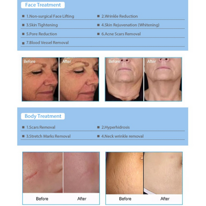 RF Microneedling Course