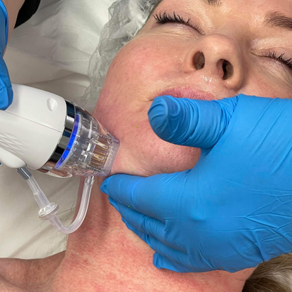 RF Microneedling Course